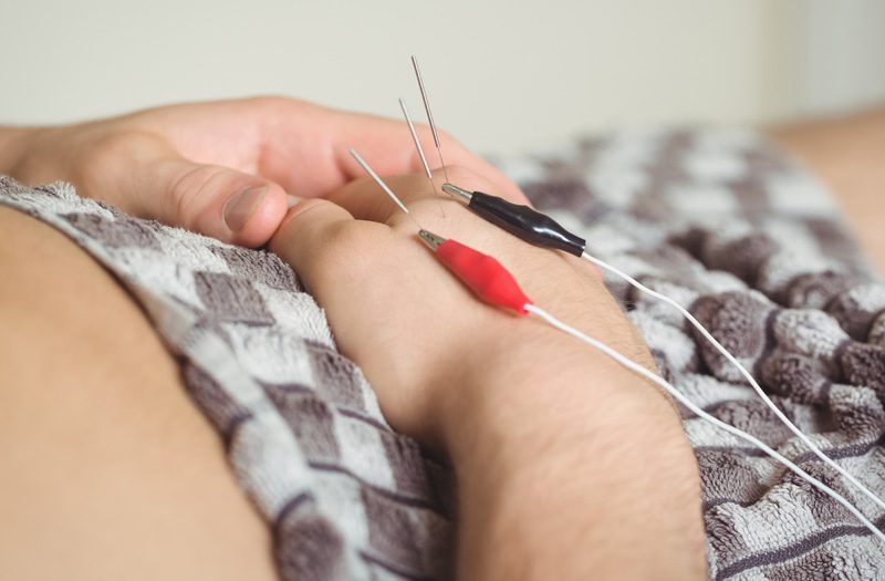 dry needling with electrodes HamptonPT