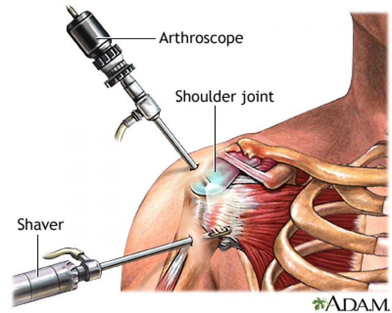 Arthroscopic Repair of the Rotator Cuff: How is it Done? What to Expect? -  Shoulder & Elbow